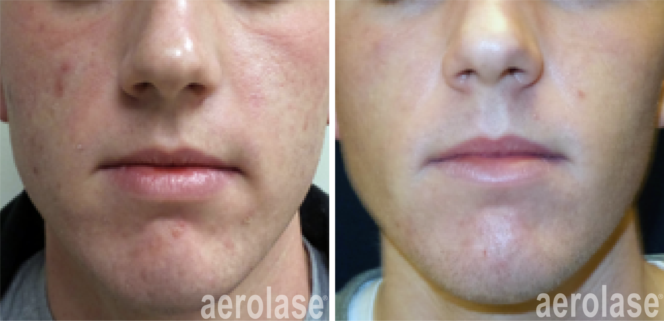 Aerolase Acne Treatment