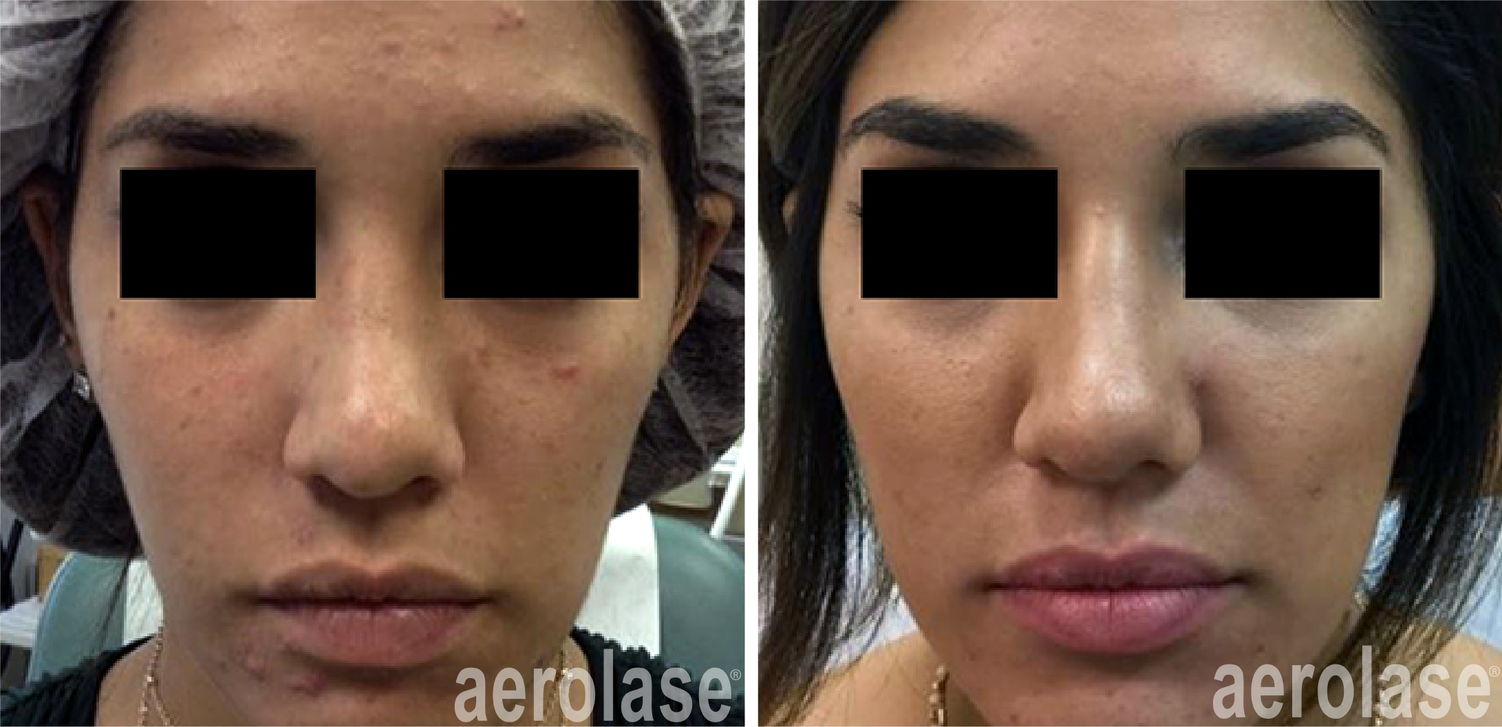 Aerolase Acne Treatment